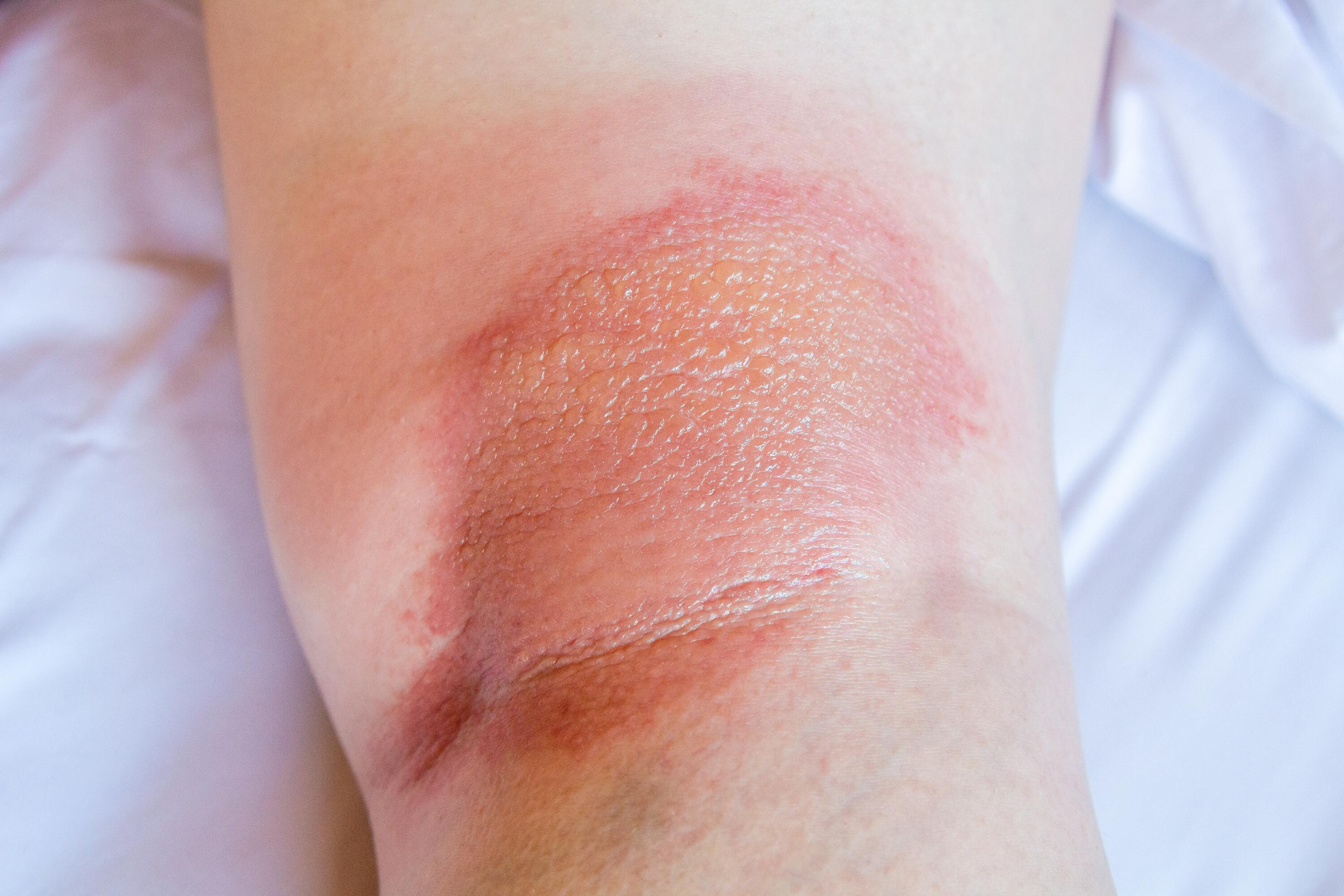 chiazza di eczema